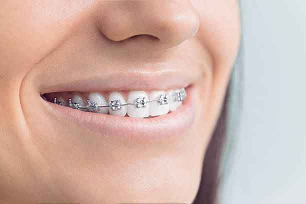 Best Traditional Braces  in West Covina, CA